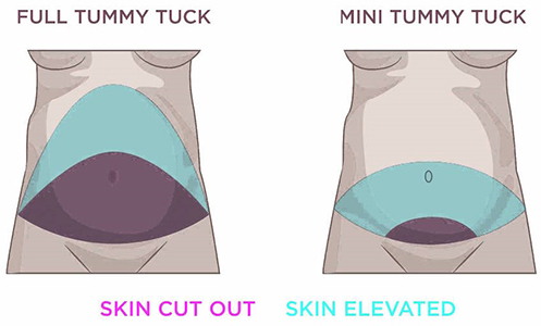 Mini-abdominoplasty-versus-abdominoplasty